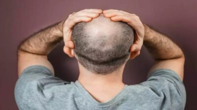 Büyüden bilimsel tedavilere, Jül Sezar’dan Hipokrat’a kadar saç dökülmesine karşı