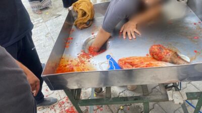 Şanlıurfa’da 16 yaşındaki kız çocuğunun salça makinesi merdanesine kaptırdığı eli,