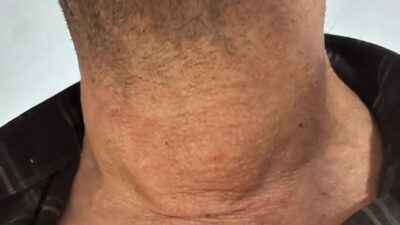 Kütahya Evliya Çelebi Eğitim Araştırma Hastanesi Girişimsel Radyoloji Biriminde olağanüstü