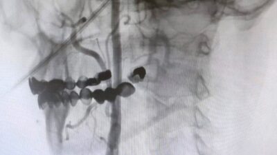 Manisa Şehir Hastanesi’nde, beyin damarlarındaki tıkanıklıklara karşı ameliyatsız stent yöntemi