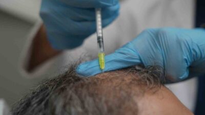 Toplumda yaygın görülen saç dökülmesinin vücudun verdiği önemli bir “sağlık